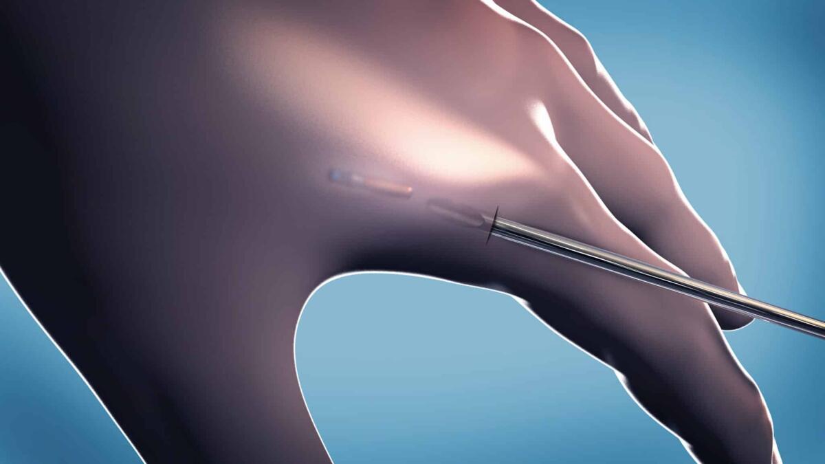 Chip sottopelle NFC: da oggi è possibile in Svizzera - Sub dermal microchip implant or transponder implanted into human hand - 3d illustration