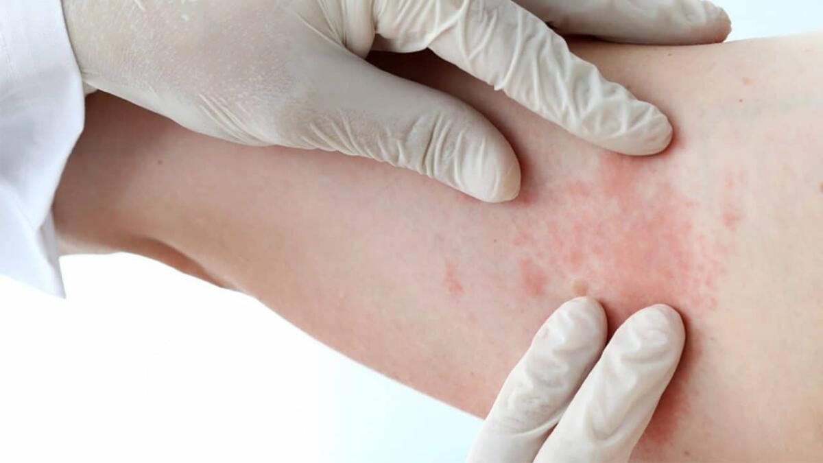 Dermatite atopica: sintomi, diagnosi, impatto socioeconomico - 