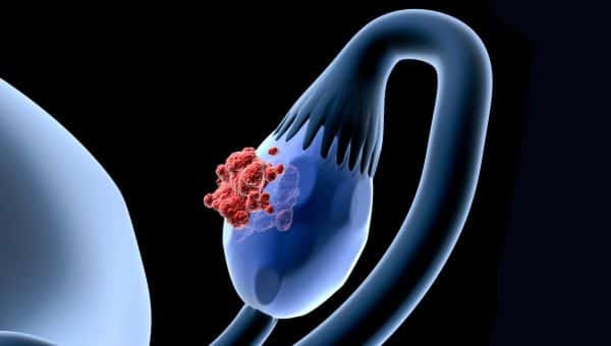 Teratomi ovarici e cisti dermoidi: cosa sono, formazione, sintomi - 