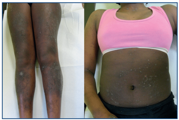 Ragazza di 14 anni affetta da dermatite atopica. Credits: Sintesi infomedica.it; Overiew su dermatite atopica e comorbidità
