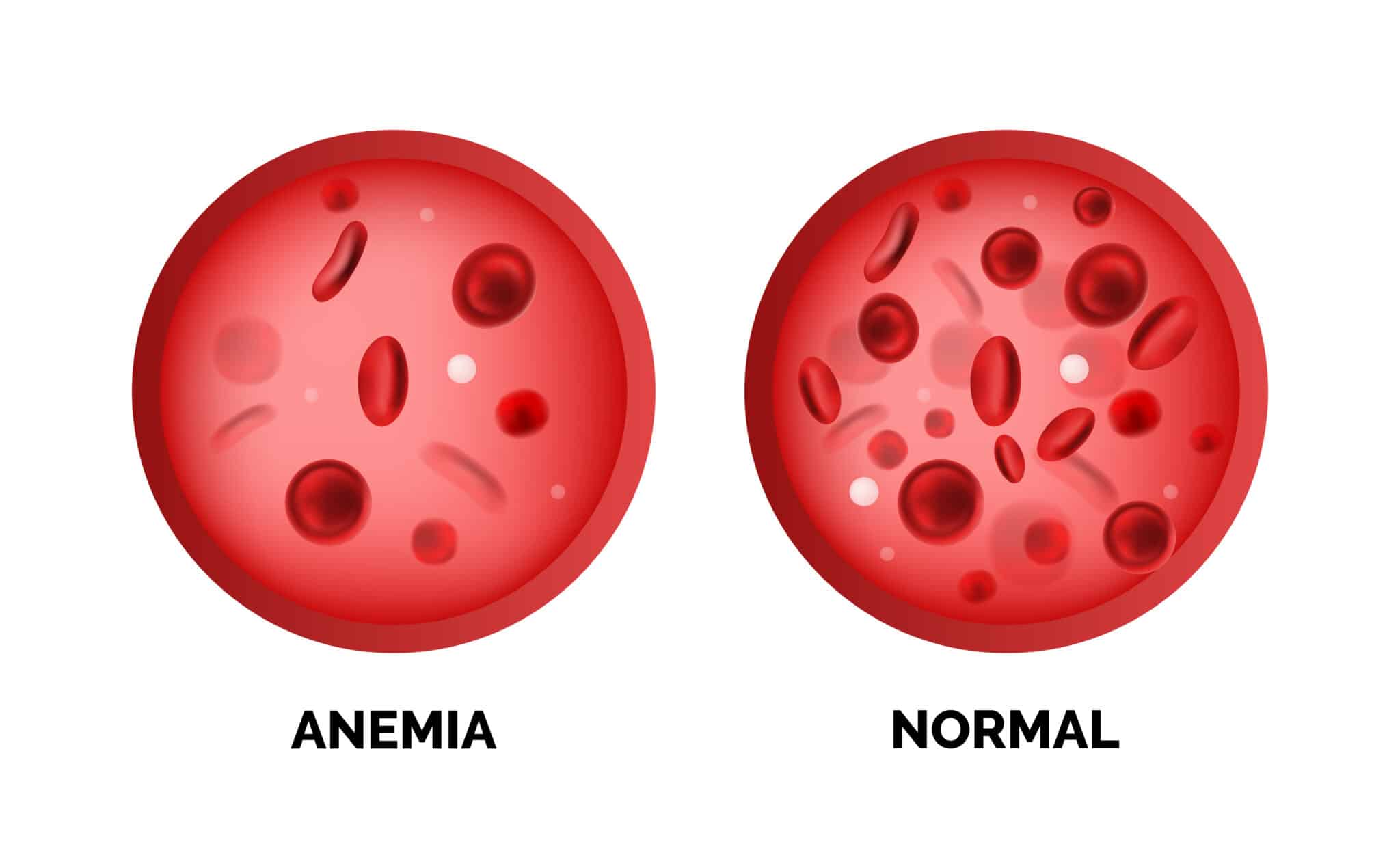 leucemia