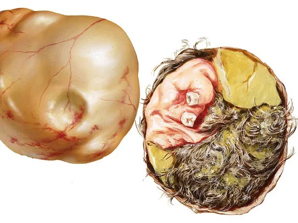 Immagine di un teratoma ovarico, più precisamente una cisti dermoide, direttamente dal profilo Twitter del Prof. Salvo di Grazia