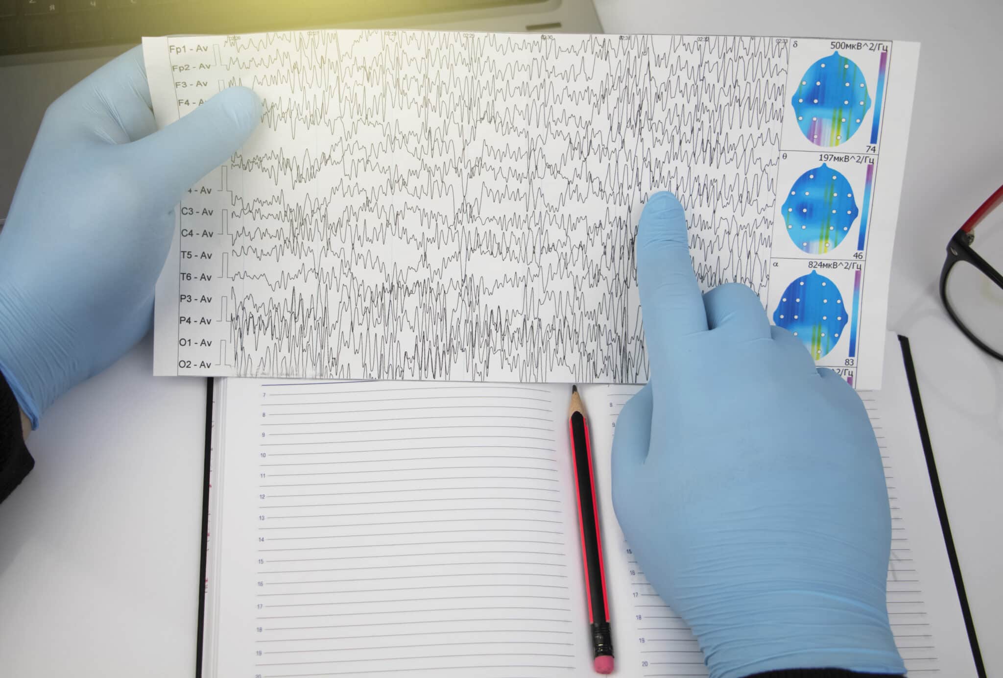 EEG crisi convulsive crisi convulsive febbrili nel bambino