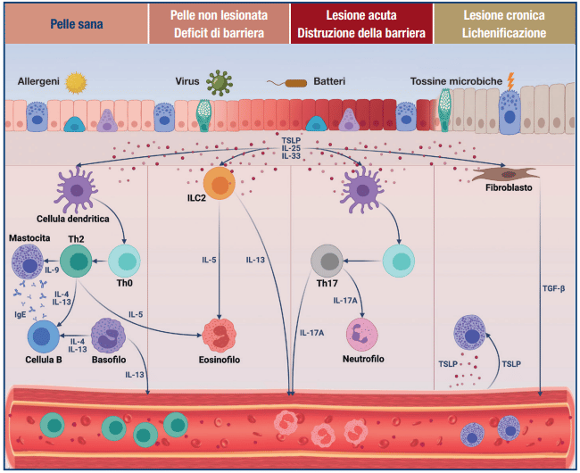Patofisiologia della dermatite atopica. La cute clinicamente sana ha una disfunzione epidermica di barriera con una riduzione dell’eterogeneità del microbioma. Nella cute lesionale le cellule di Langerhans, cellule dendritiche infiammatorie epidermiche, s