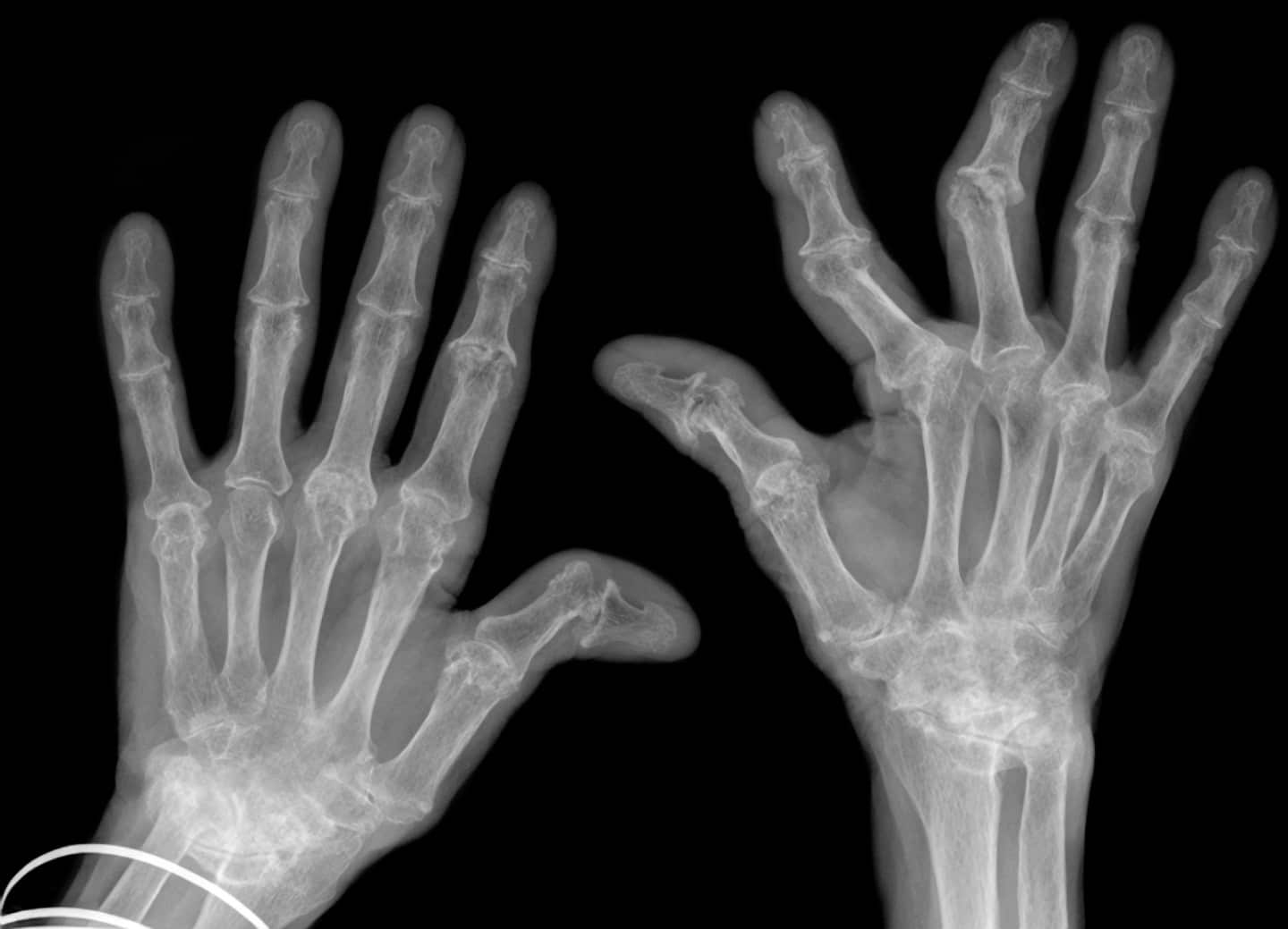 Artrite reumatoide: anche i pazienti con dita gravemente piegate possono ricevere un trattamento ottimale con un impianto FingerKIt mediante AI - Credits: © iStock, WILLSIE