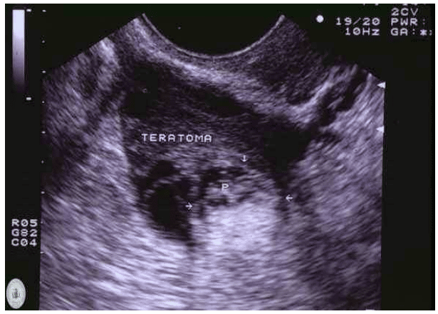 Immagine ecografica di un teratoma immaturo. L'immagine è stata riportata dalla Dott.ssa A. Codroma. Credits: Dipartimento di Scienze Ginecologiche e della Riproduzione Umana Scuola di Specializzazione in Ginecologia e Ostetricia, Università degli studi d