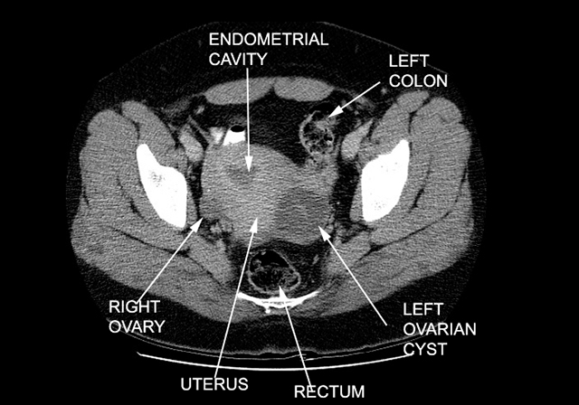 Esempio di una sezione di addome femminile in RMI con indicazioni delle parti anatomiche. E' possibile osservare la ciste presente presso l'ovaio sinistro. Credits: Bilateral ovarian dermoid cysts