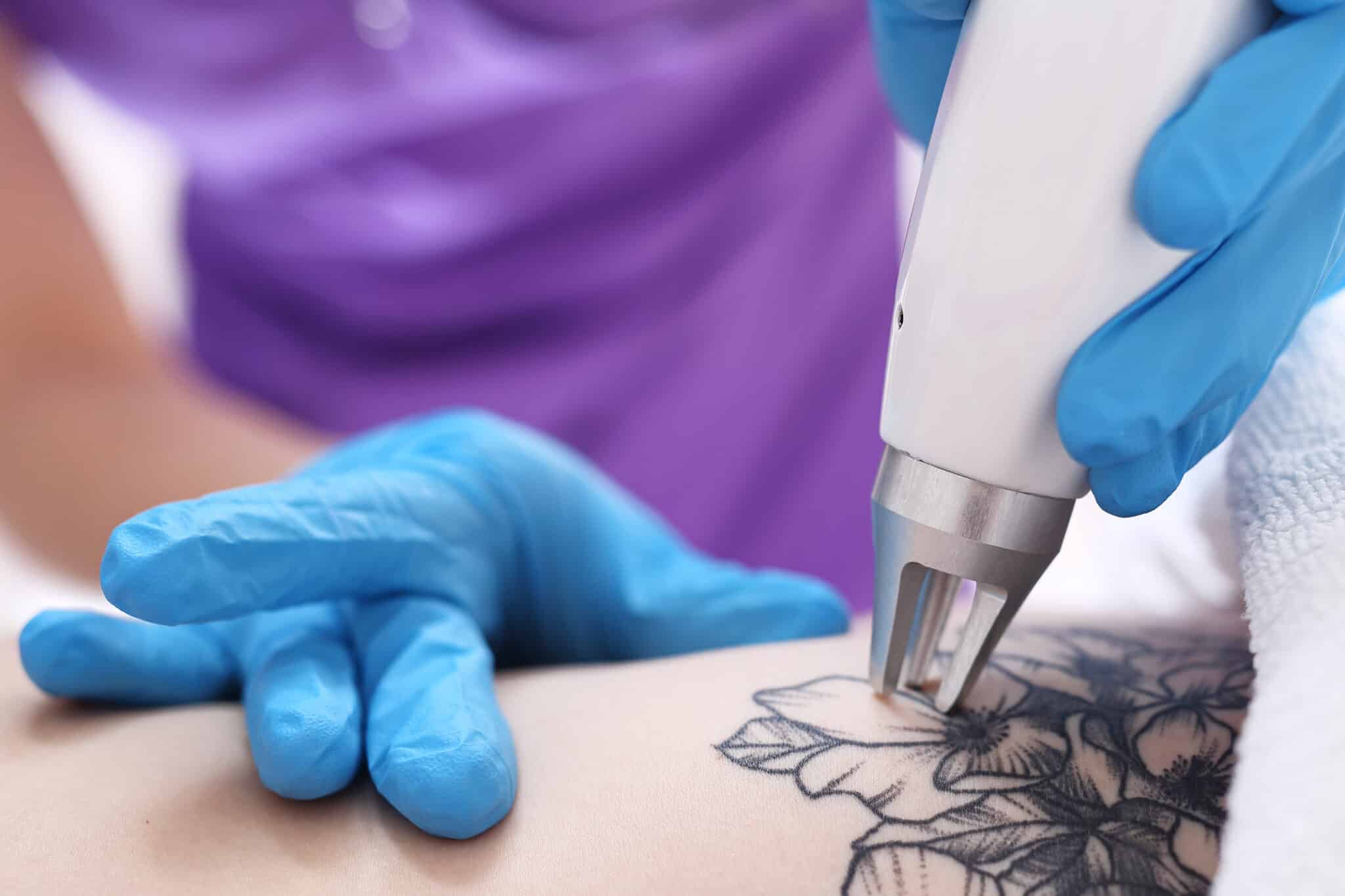 macrofagi rimozine tatuaggio