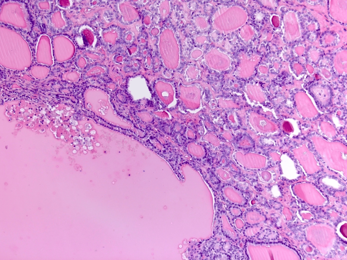 Immagine istologica di struma ovarico. Credits: Ovary Germ cell tumors Struma ovarii