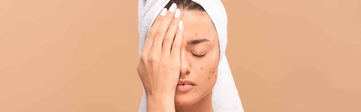 Acne: cause, tipi, diagnosi e trattamento - 