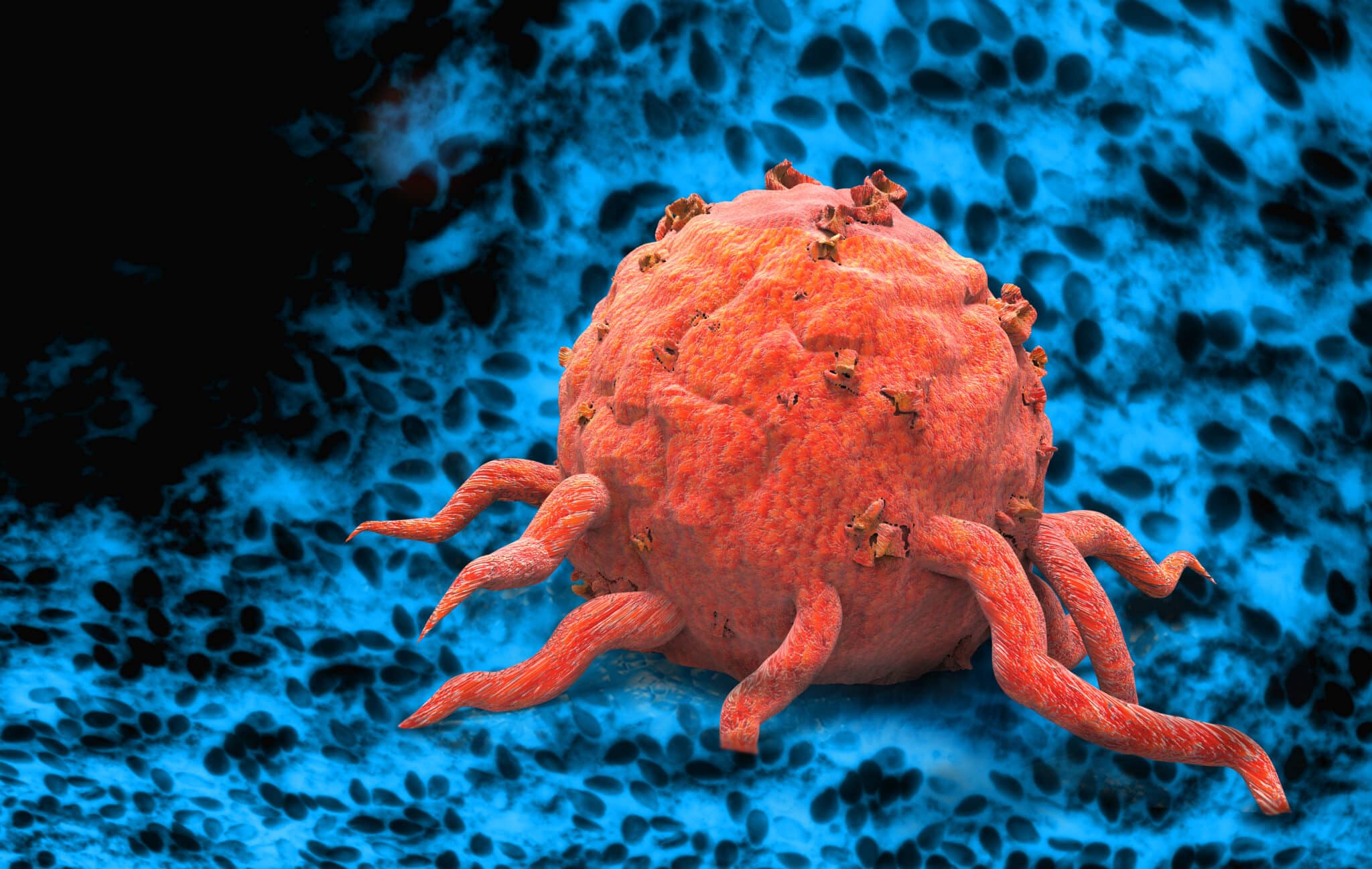 tumore pancreas diversi stadi