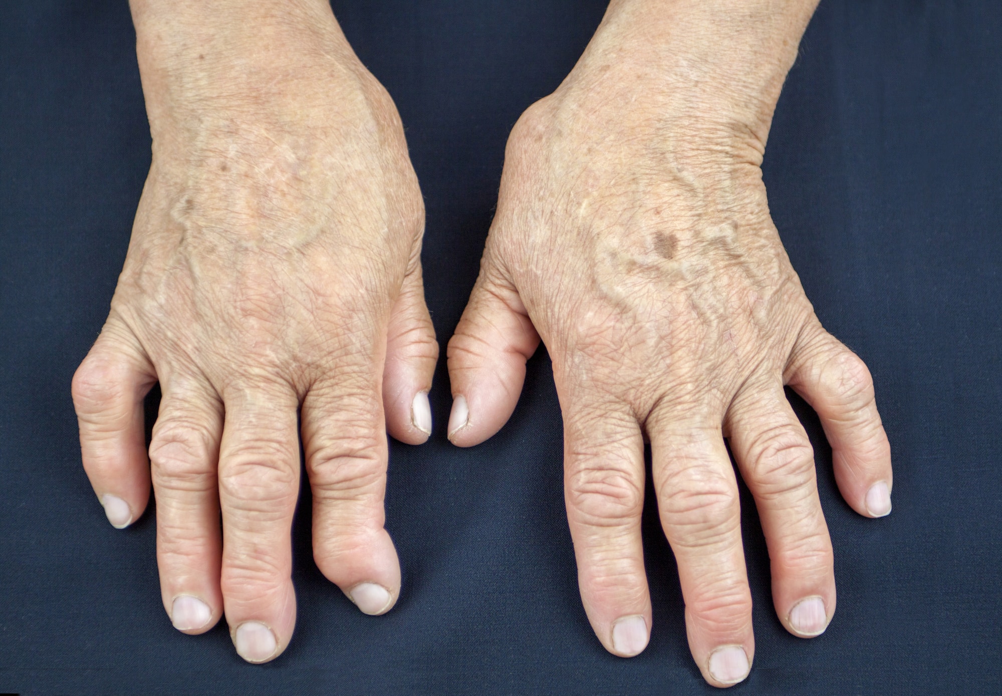 In figura delle mani di una paziente afflitta da artrite reumatoide, sono visibili le tipiche dita formate dalla malattia.