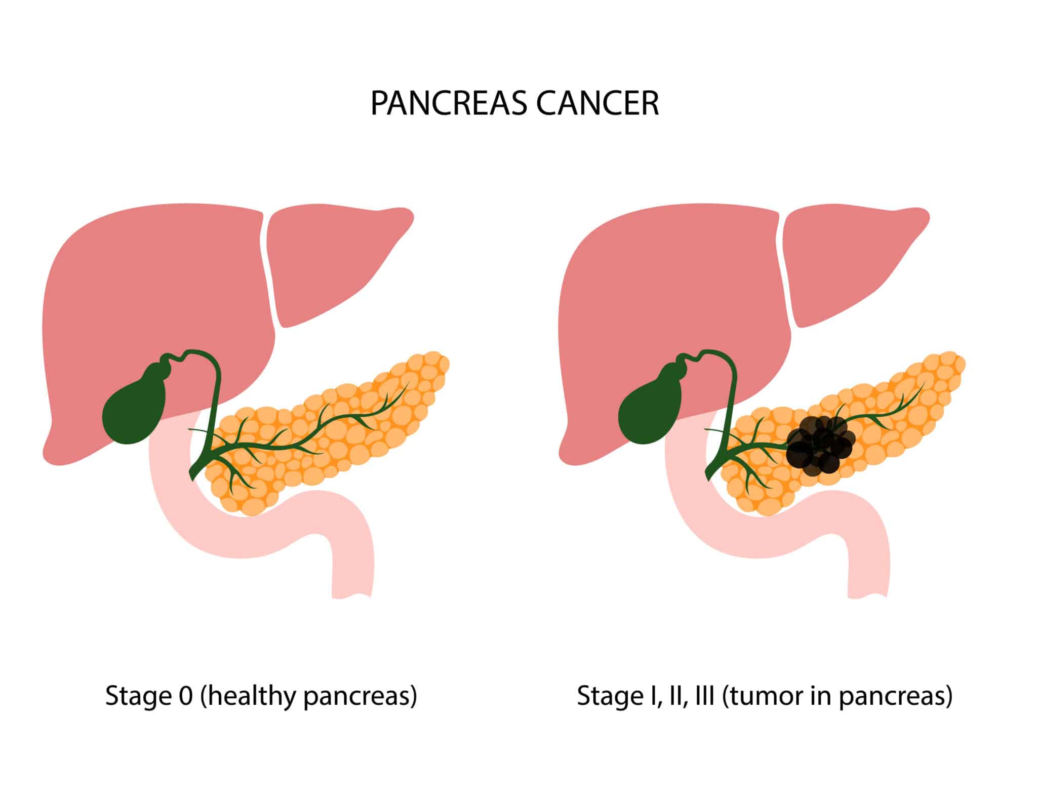tumore al pancreas