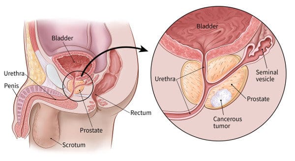 Tumore alla prostata: anatomia - Credits: American Cancer Society