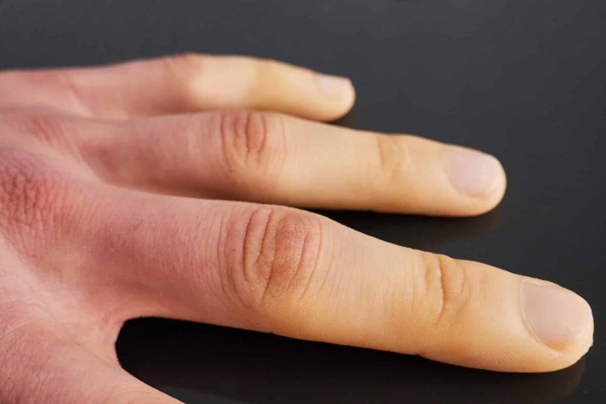 Sindrome di Raynaud: cos'è, cause e trattamenti - white fingers from the cold, poor blood circulation