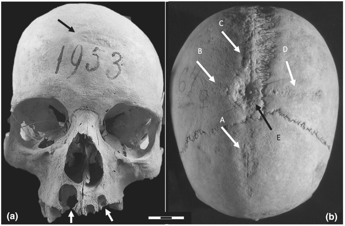 Chirurgia cranica: il primo caso nell'Italia Longobarda - 