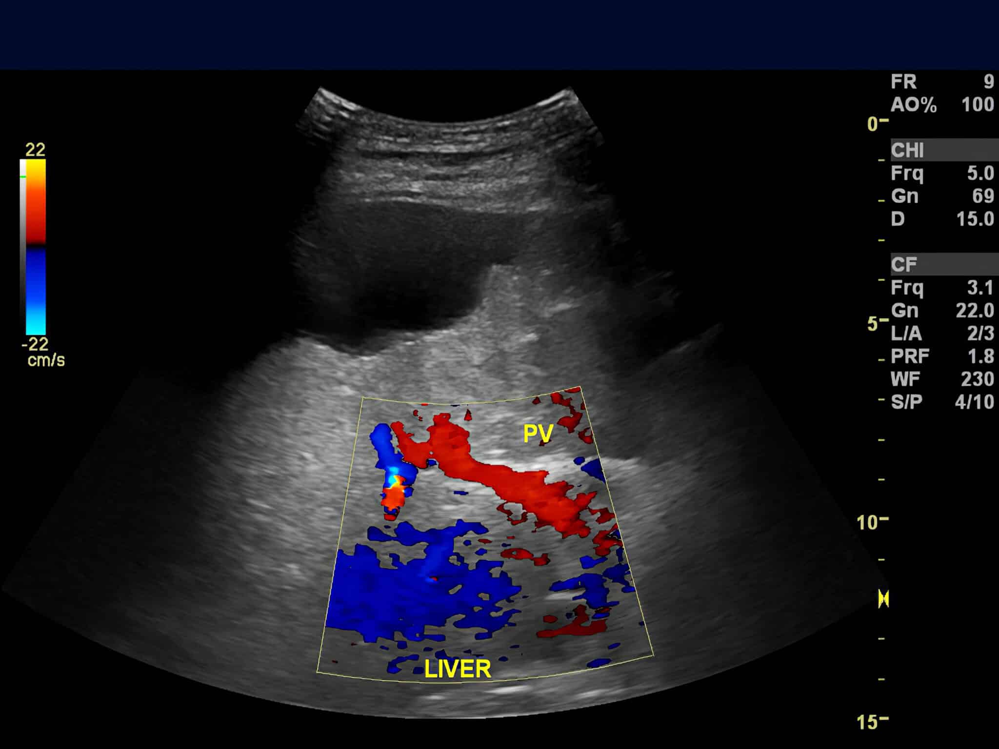 Esempio di Eco-Color-Doppler addominale