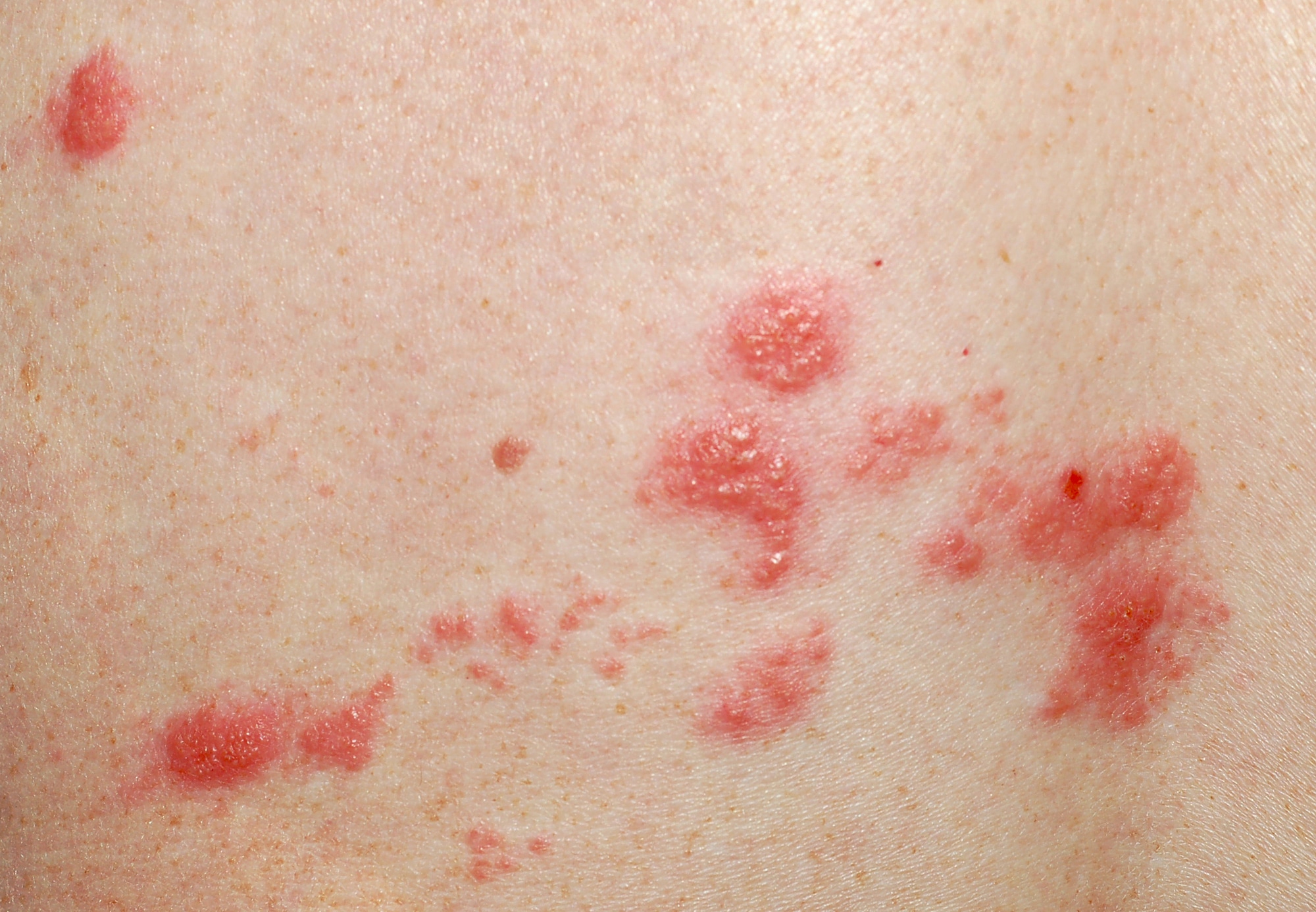 Eruzione cutanea causata dall'Herpes Zoster.