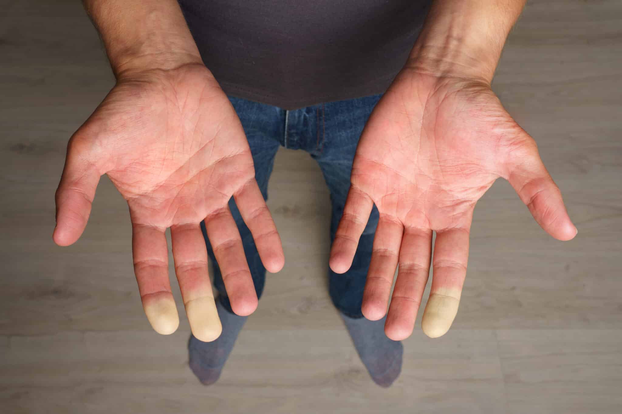 sindrome di Raynaud
