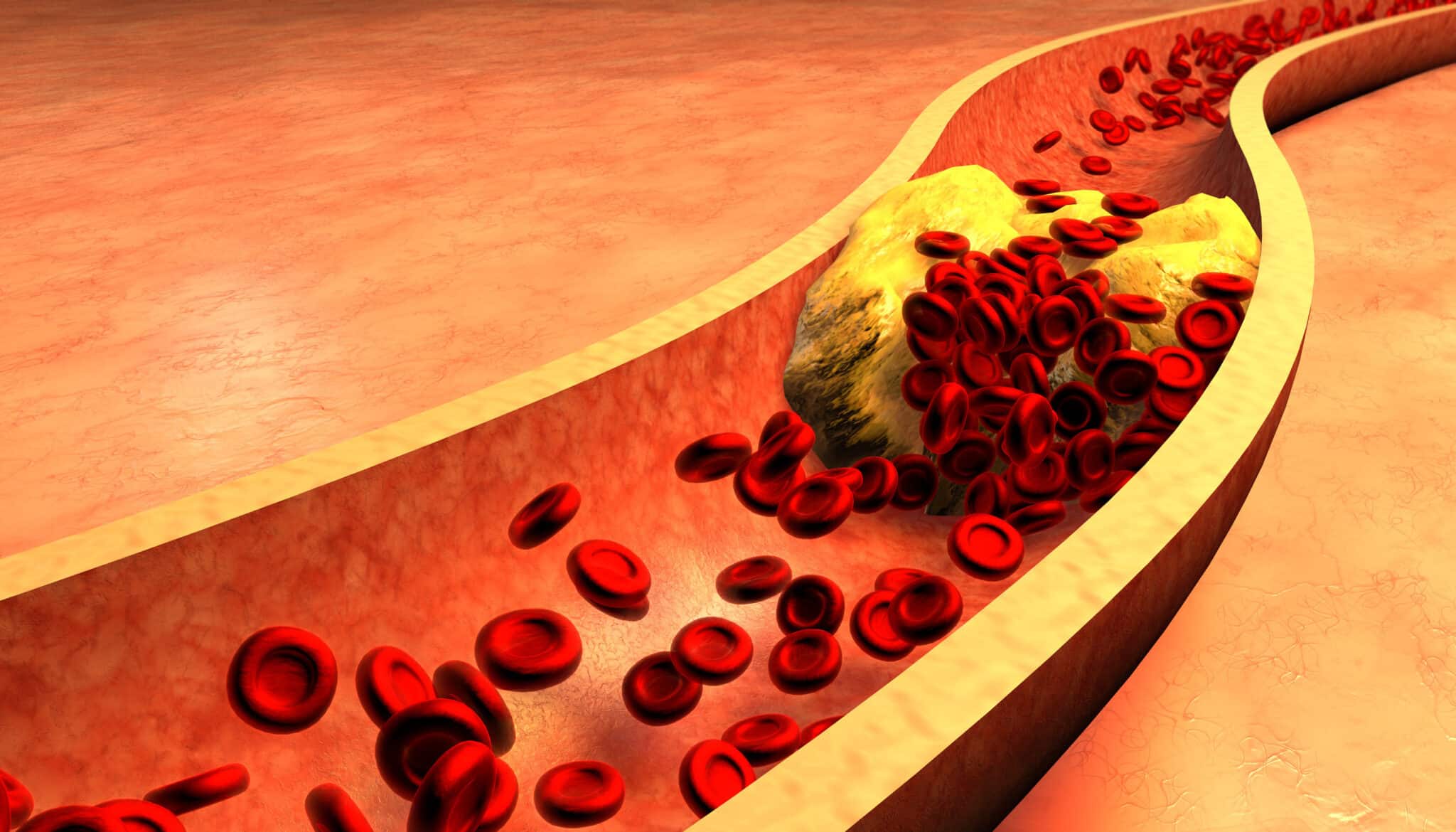 epidemiologia sindrome di Reynaud