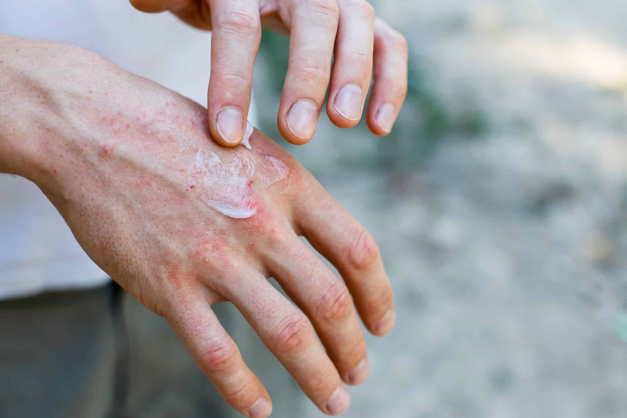 Sindrome di Raynaud: cos'è, cause e trattamenti