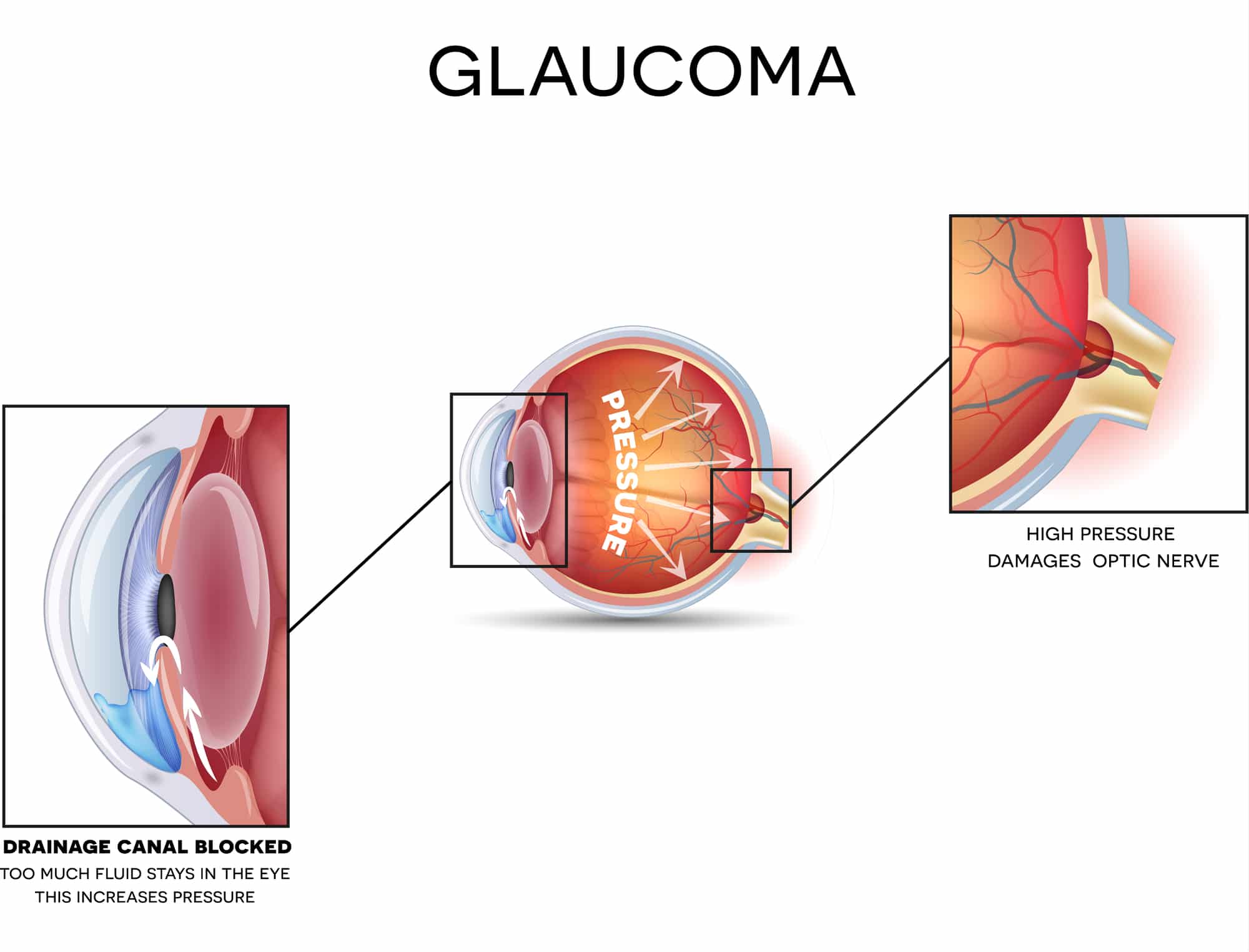 Glaucoma: dettagli anatomici del disturbo.