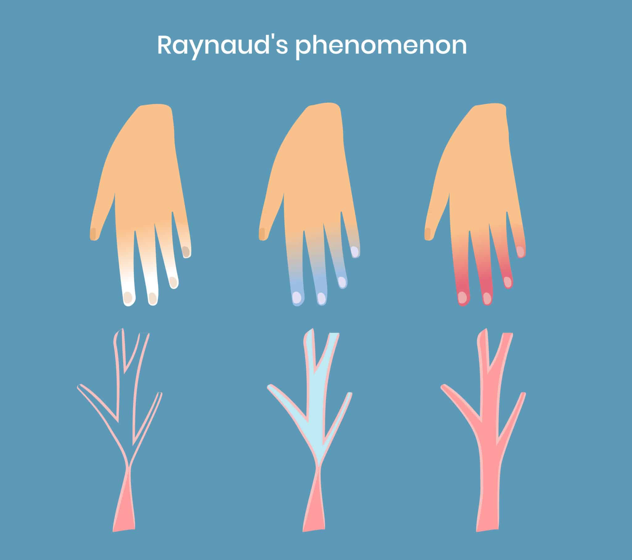 Sindrome di Raynaud: cos'è, cause e trattamenti