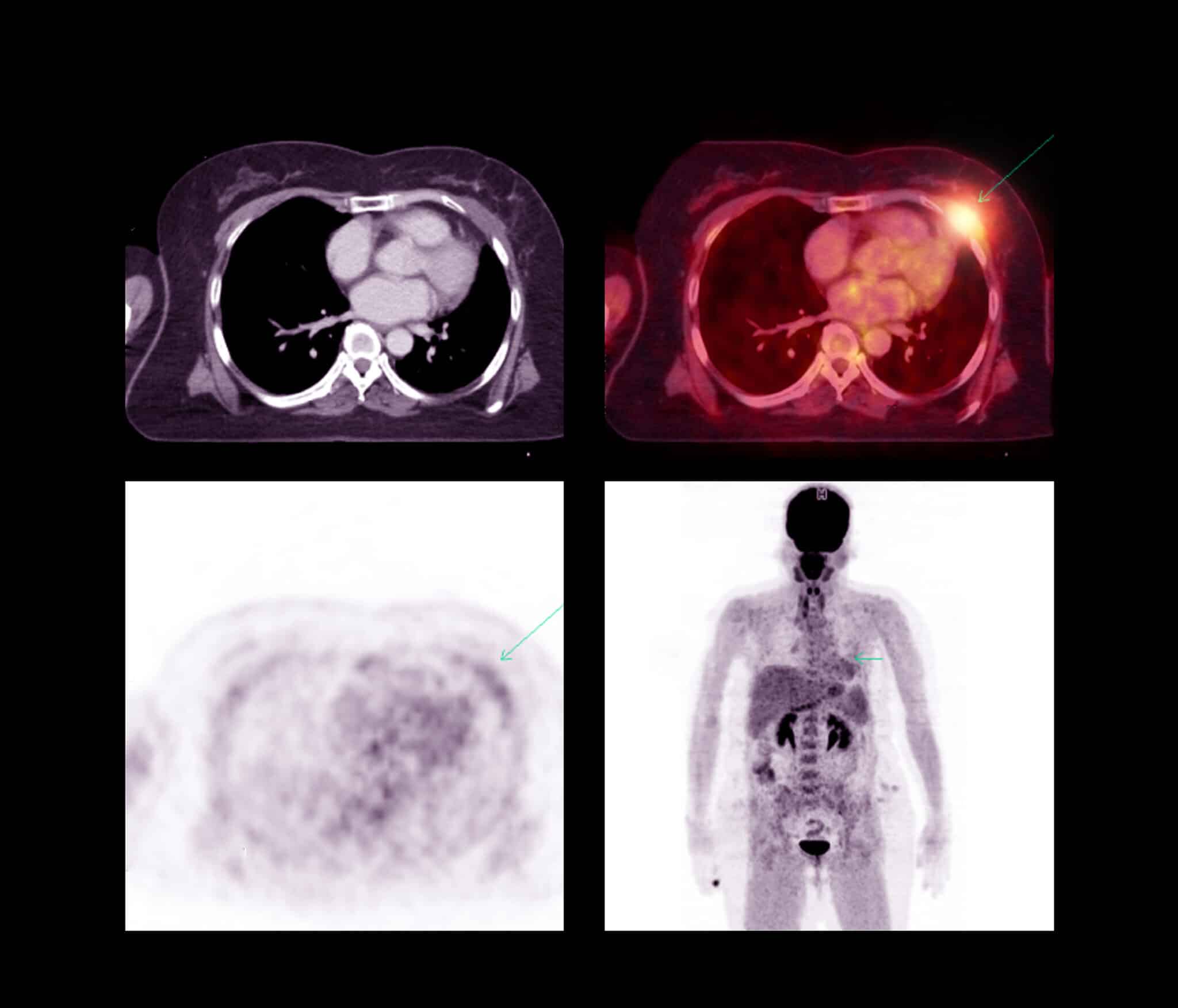 In alto a sinistra l'immagine di una TC a destra di una PET TC per rilevare la recidiva del cancro nella malattia del cancro del polmone del paziente