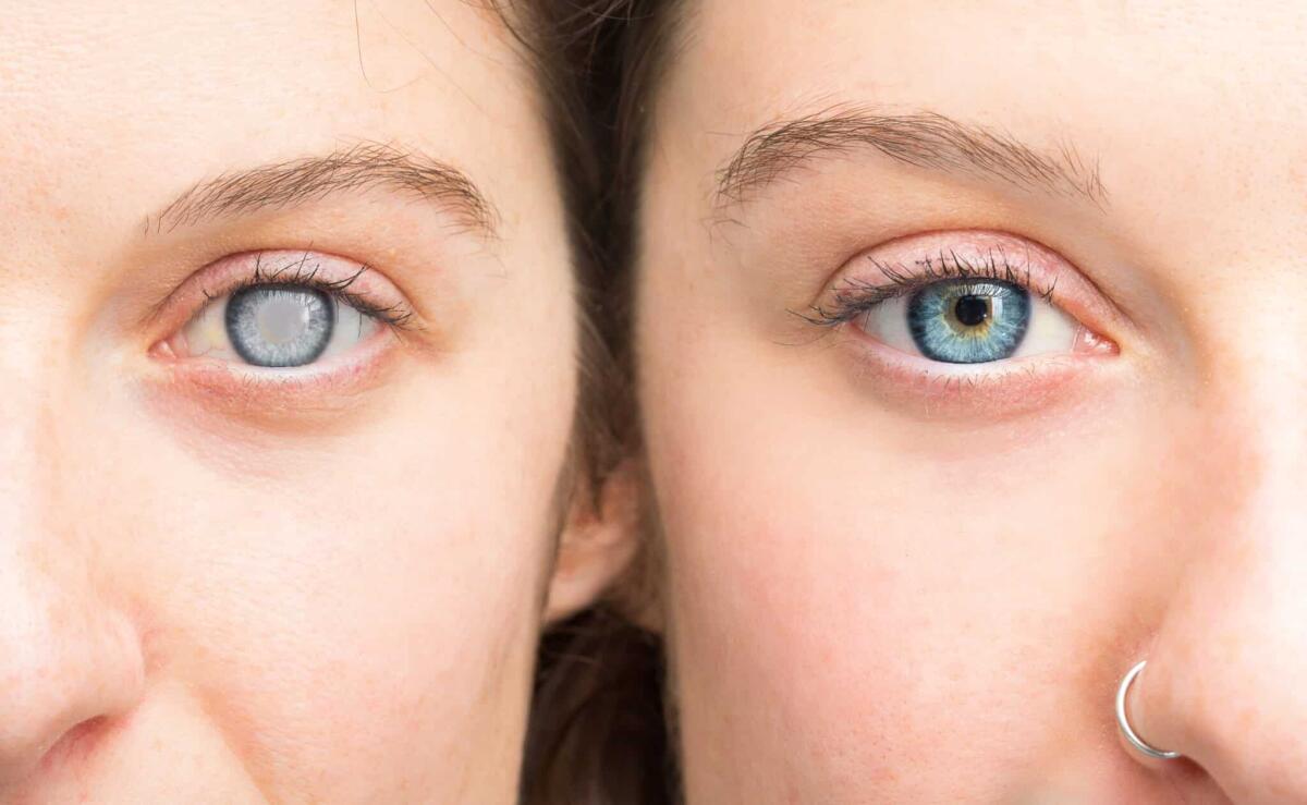 Glaucoma: cos'è, sintomi, diagnosi e trattamento - 
