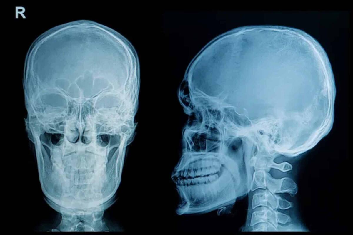 Fisioterapia delle articolazioni temporo mandibolare (ATM) : sempre più pazienti ne fanno richiesta - 