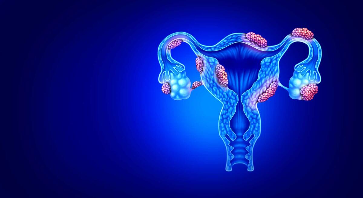 Endometriosi: scoperto legame genetico con altre patologie - Endometriosi