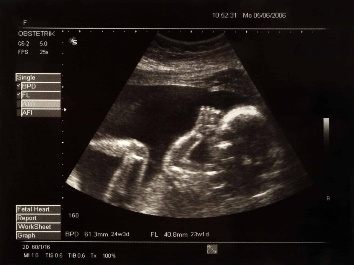 Bambino di pietra: cos'è questa gravidanza extrauterina rara - Picture of a baby in the belly of her mother
