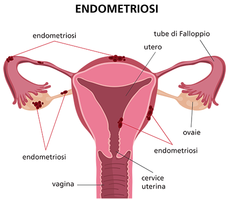 In figura è visibile l'apparato riproduttore femminile in cui  sono evidenziati i segni dell'endometriosi.