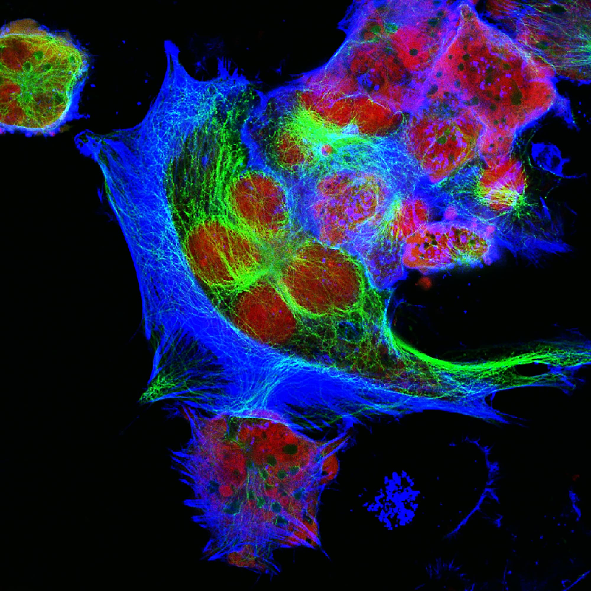 Il neuroblastoma è un cancro infantile devastante, in figura sono visibili delle cellule di questa tipologia di tumore.