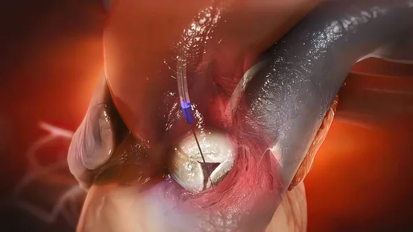 Procedura transcatetere