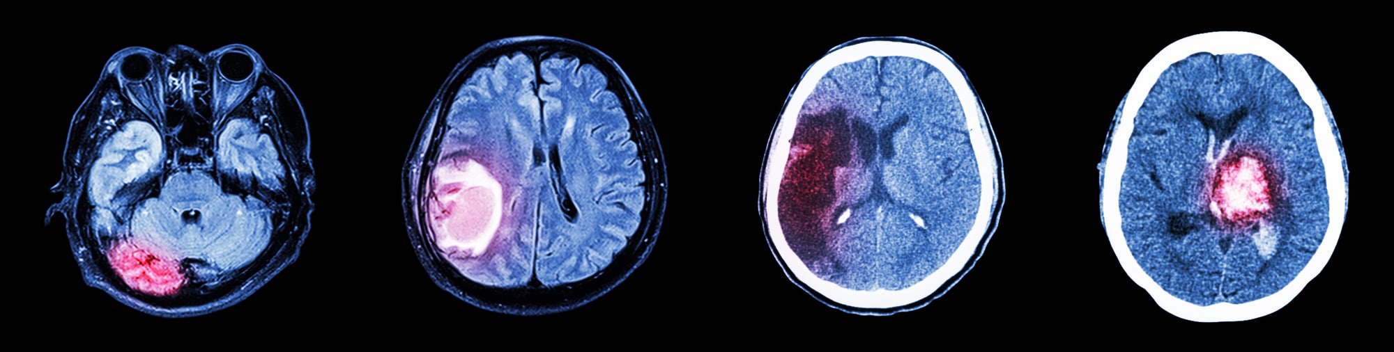 L'emorragia intracerebrale (ICH) è una malattia neurologica devastante con un alto tasso di mortalità e gravi deficit neurologici in coloro che sopravvivono.
