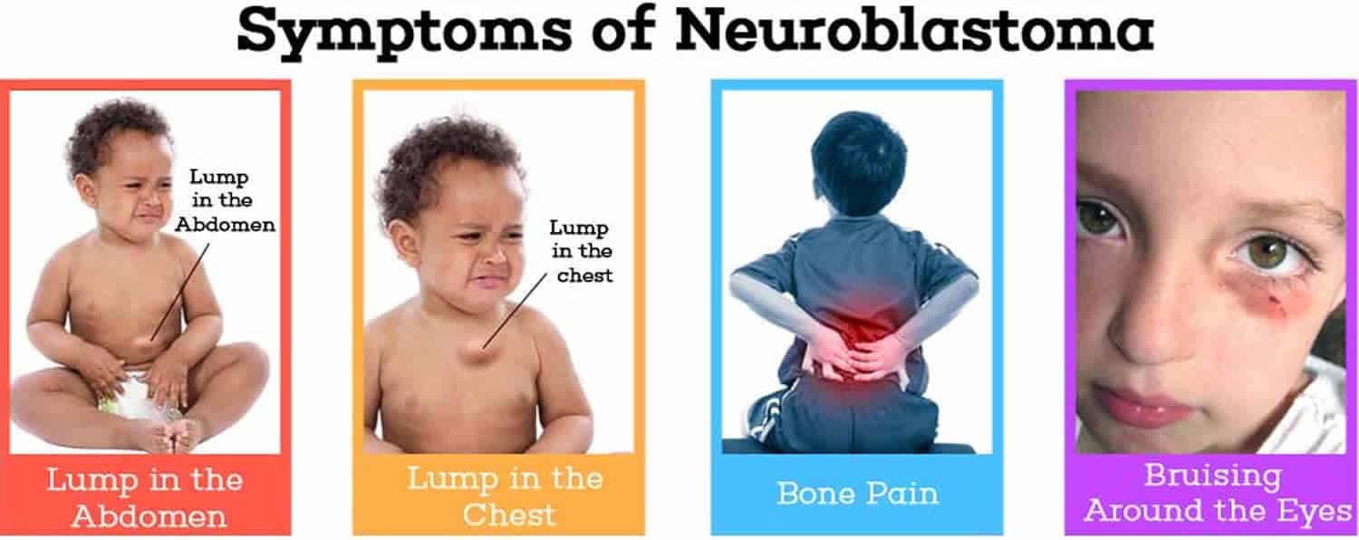Sintomatologia del neuroblastoma - Credits: American Childhood Cancer Organization