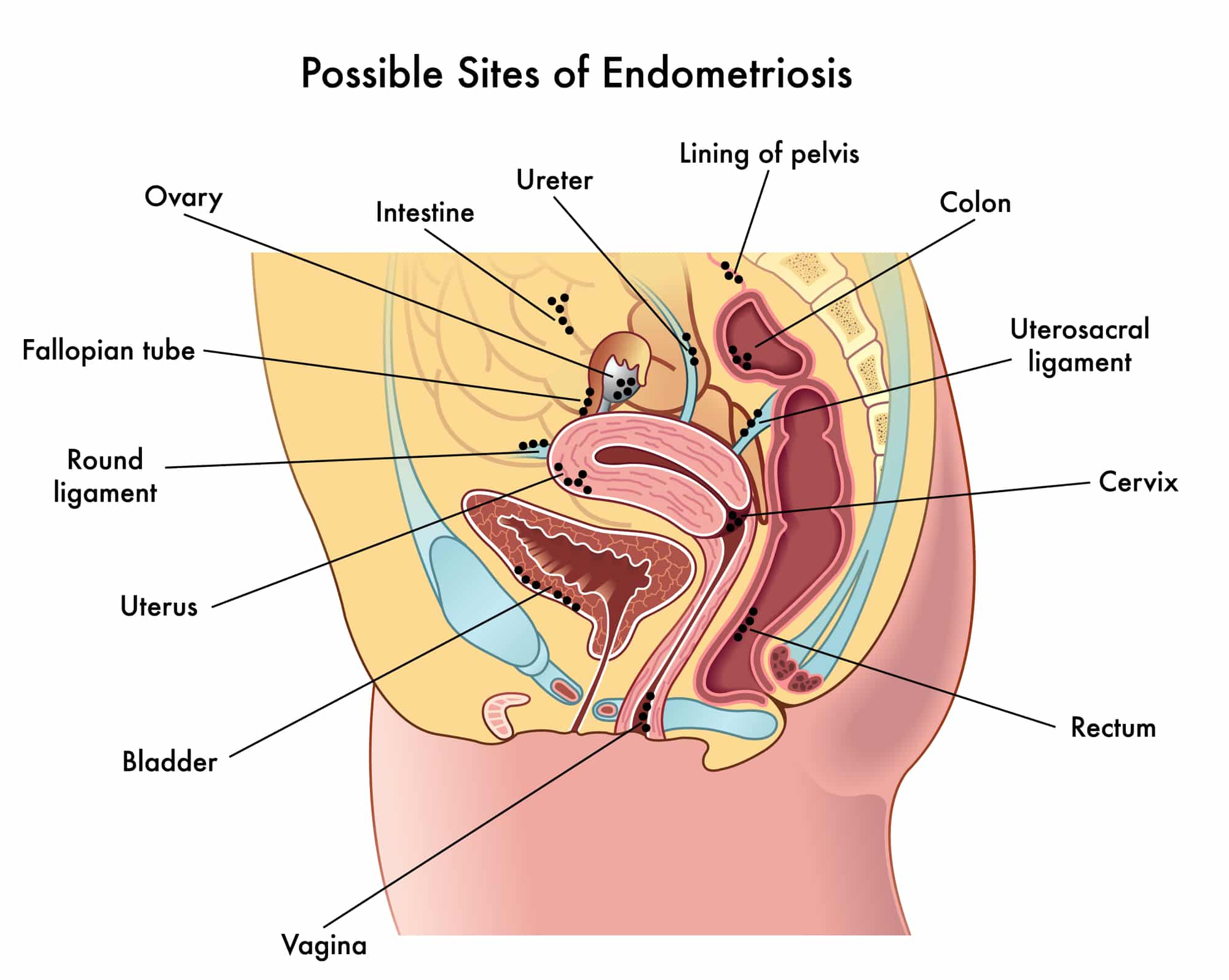 Siti interessati dall'endometriosi.