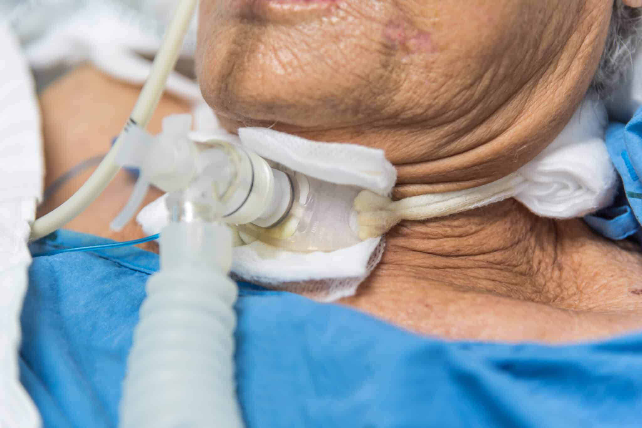 Paziente utilizza il ventilatore polmonare tramite tracheostomia.