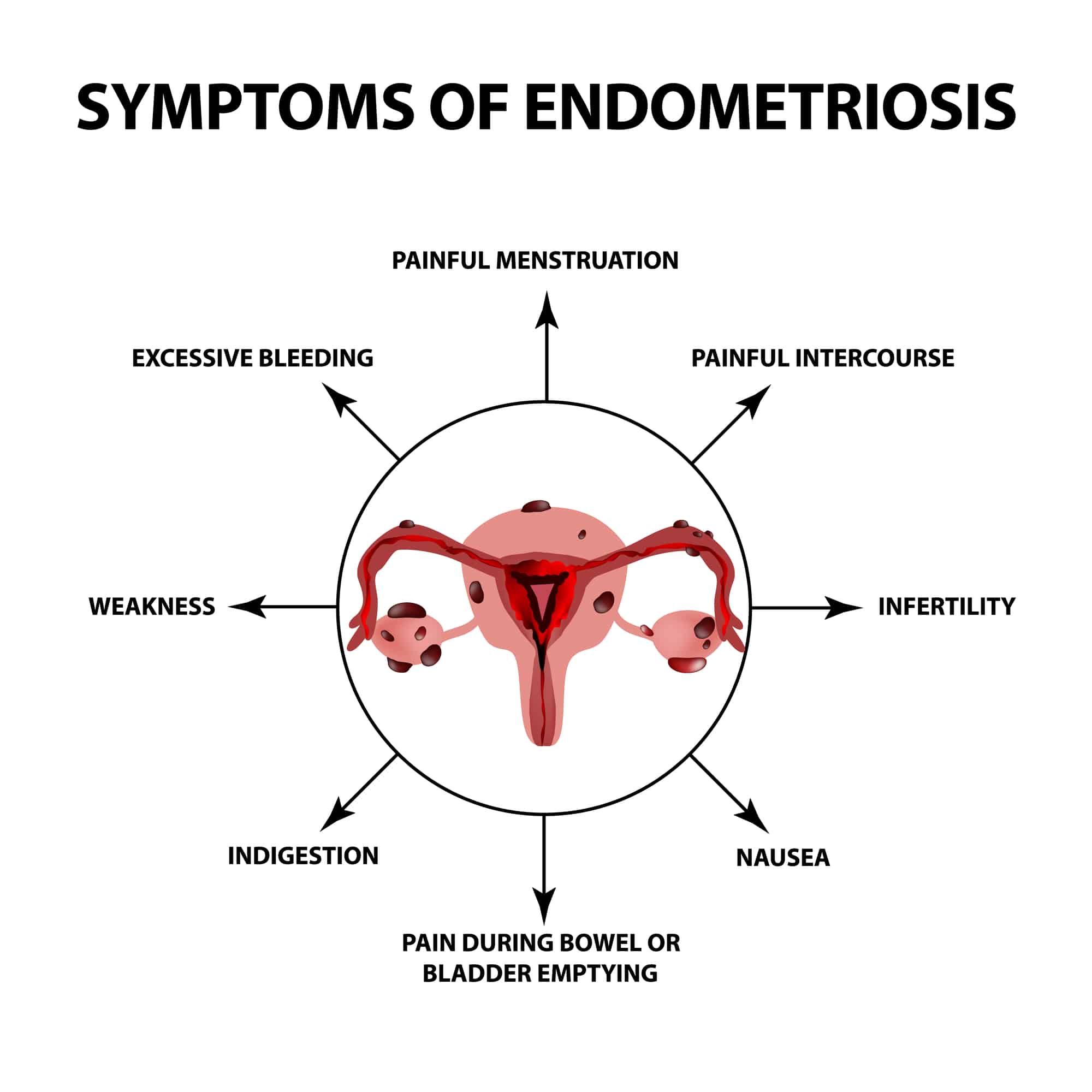Sintomatologia dell'endometriosi.
