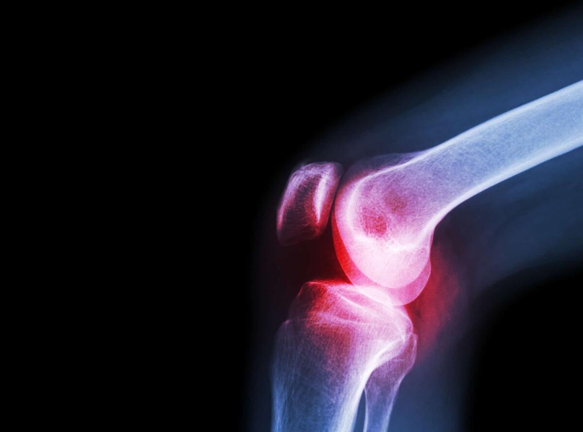 Osteoartrite: nuova terapia cellulare iniettabile - 