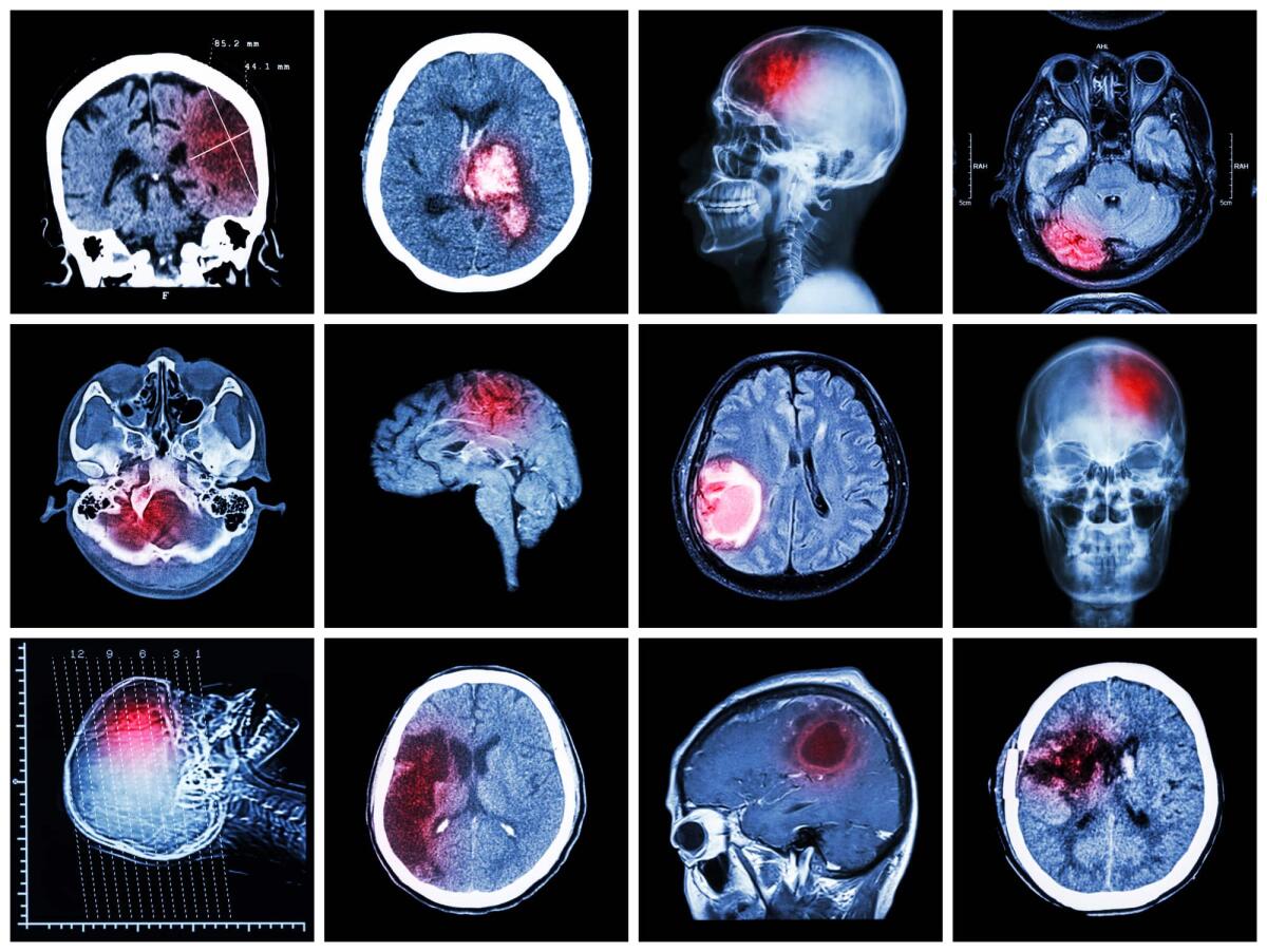Glioblastoma: dieta innesca autodistruzione del tumore - 