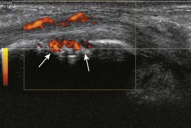 Immagine Doppler del nervo tibiale posteriore in un paziente con artrite reumatoide. C'è un aumento della vascolarizzazione nella guaina tendinea e si può vedere un'erosione sul malleolo mediale sottostante (frecce bianche) - Credits: Science Direct