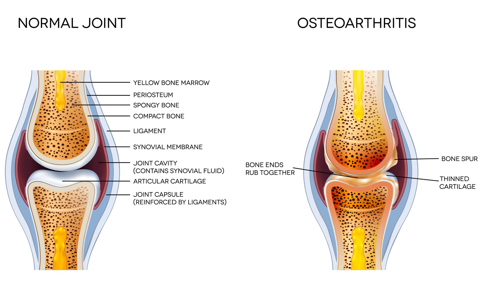 Anatomia di un ginocchio sano e di uno affetto da osteoartrite.
