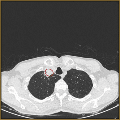 CT scan dell'ascesso. Credits: Science Direct