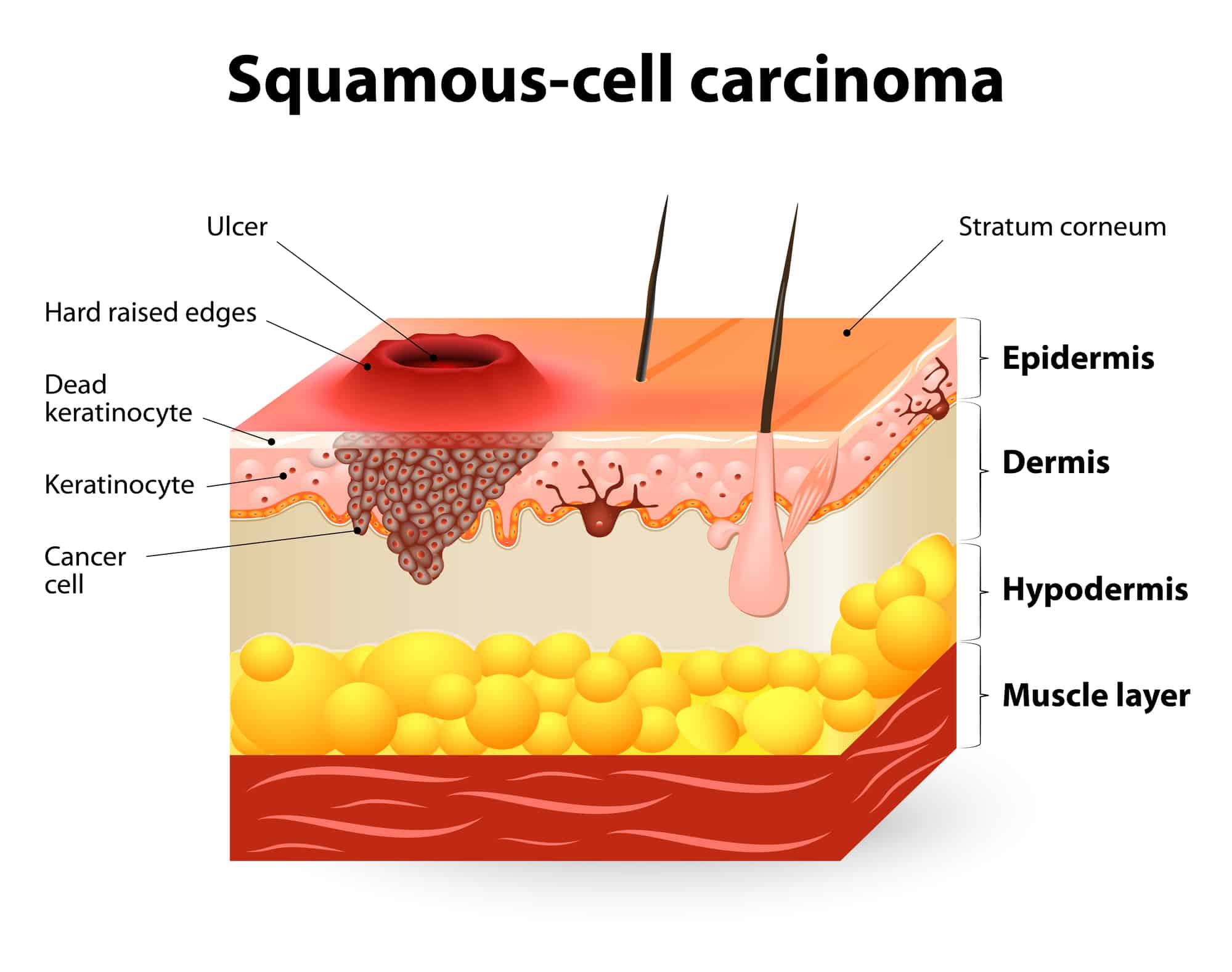 Carcinoma a cellule squamose.