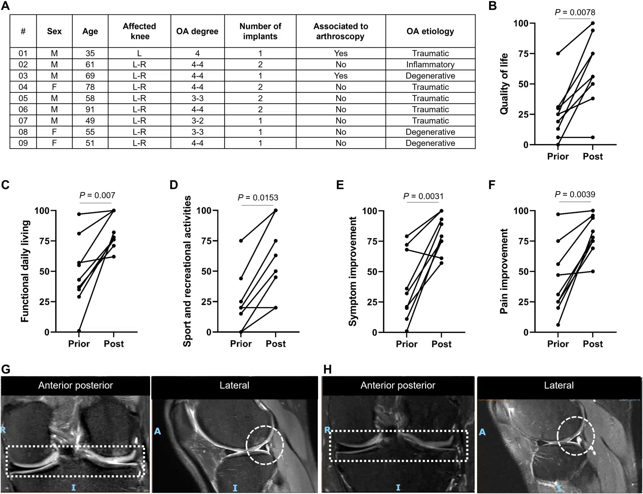 Miglioramento della rigenerazione della cartilagine articolare al trattamento autologo dell'osteooatrite indotta da traumi in uno studio clinico - Credits: Science Advances