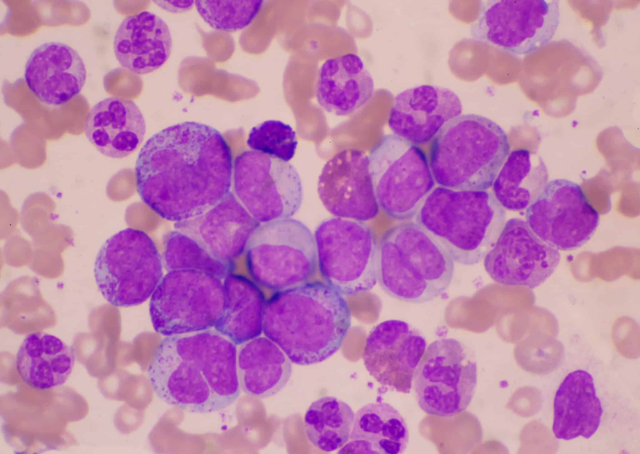 Mixed stage white blood cell on red cells background.Leukemia concept.