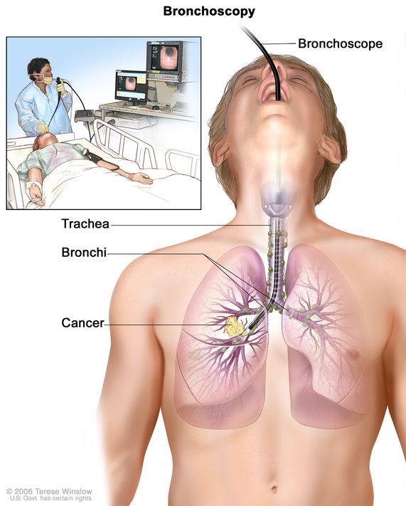 Esecuzione di una broncoscopia - Credits: National Cancer Institute