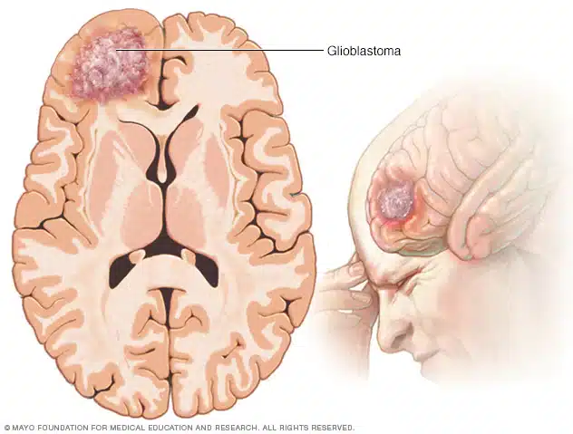 Glioblastoma - Credits: Mayo Clinic